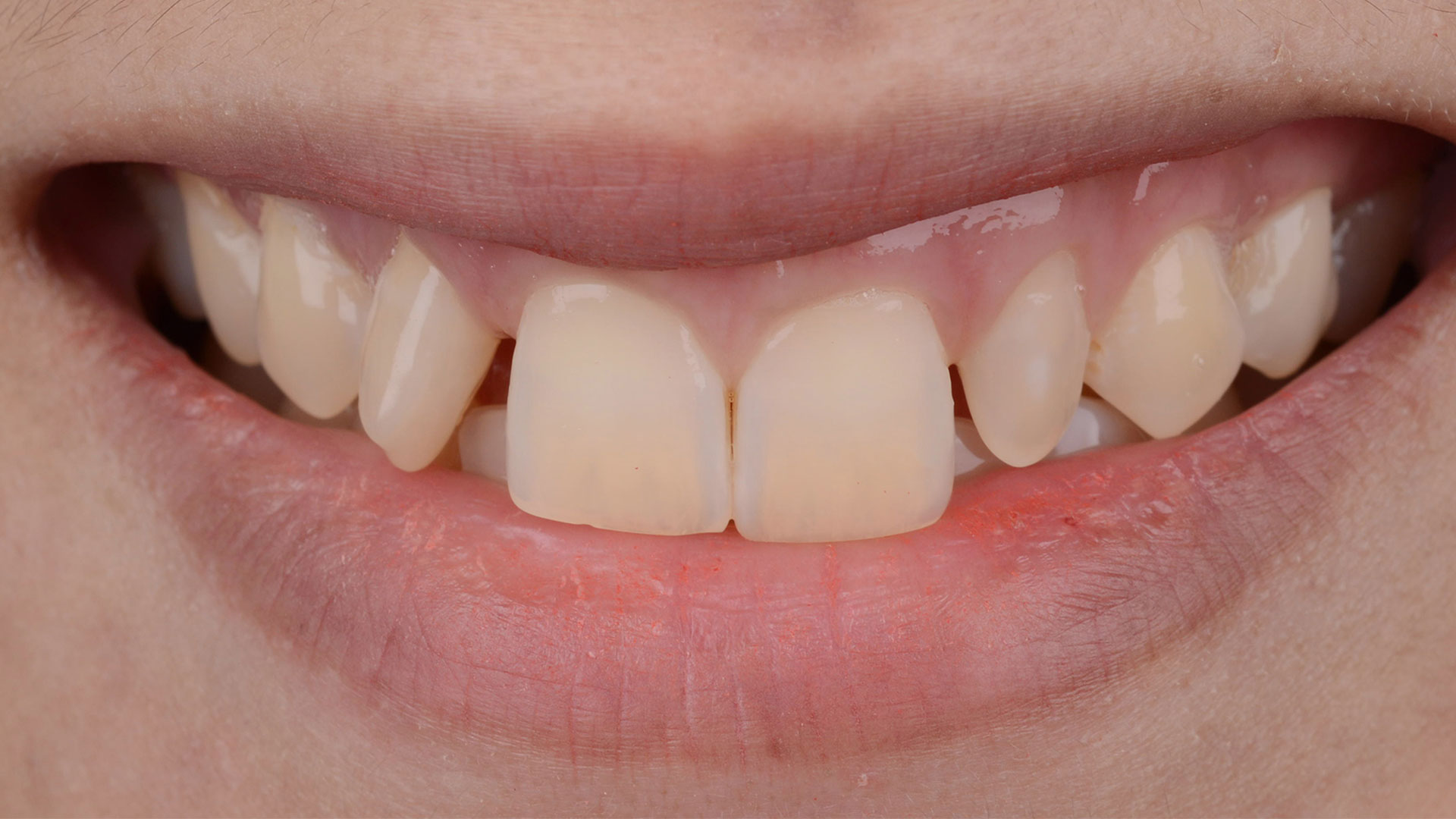 Inconistent Teeth Smile Gallery - East Towne Dental Associates